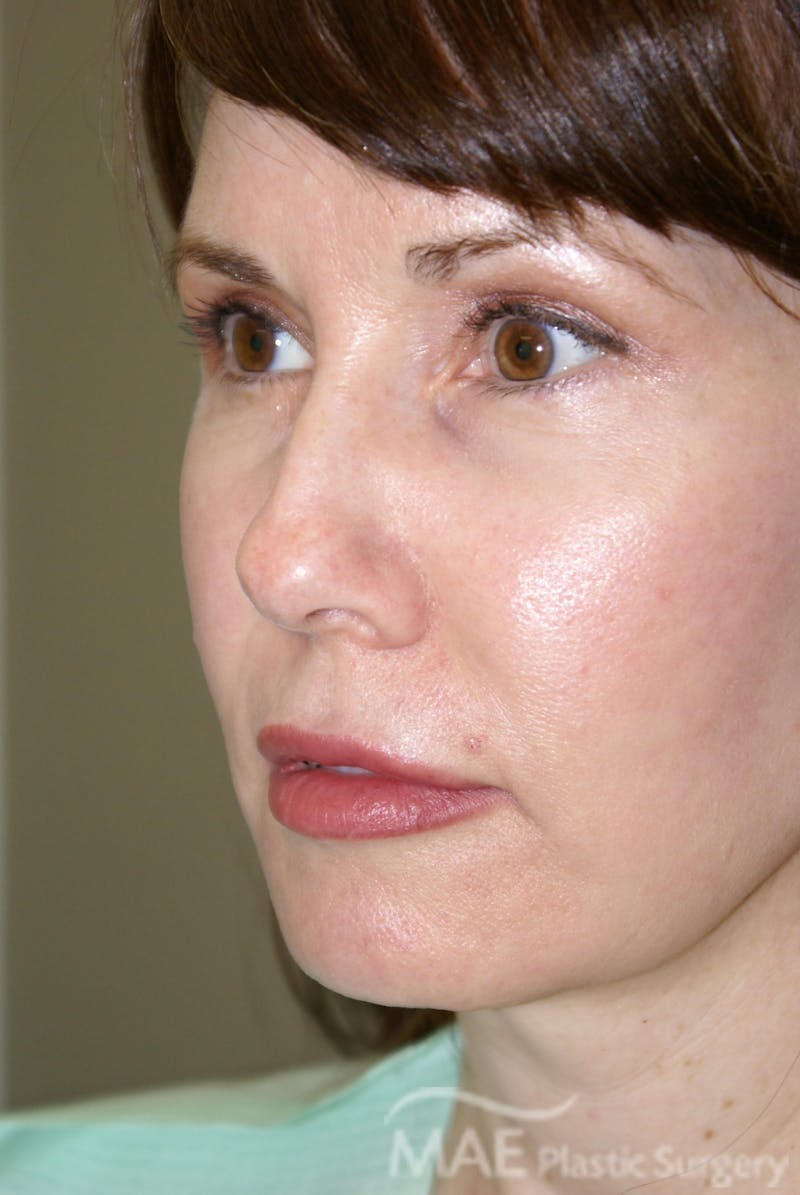Facelift Before & After Gallery - Patient 164529 - Image 4
