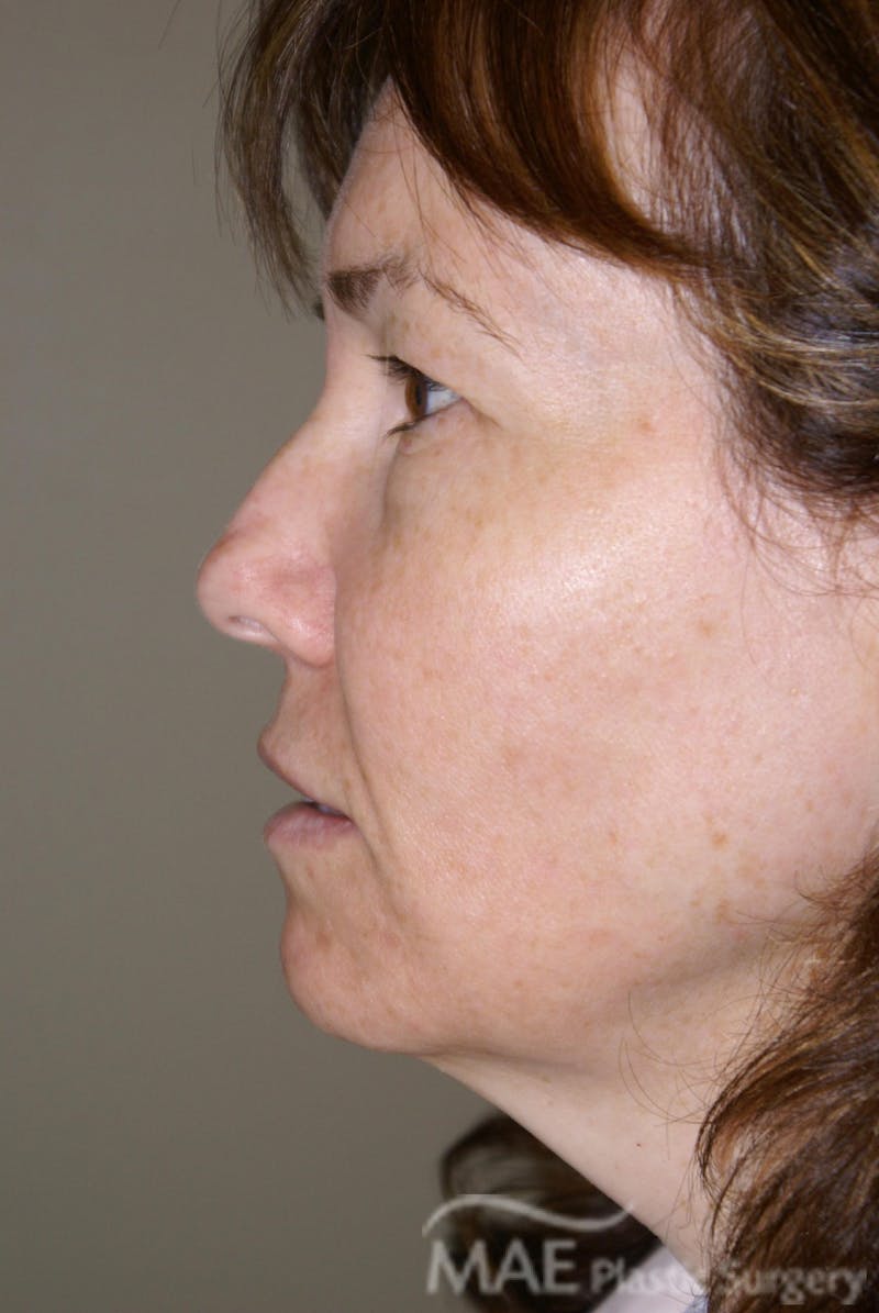 Facelift Before & After Gallery - Patient 164529 - Image 5