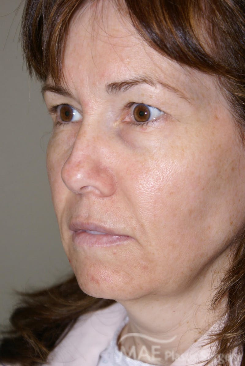 Facelift Before & After Gallery - Patient 164529 - Image 3