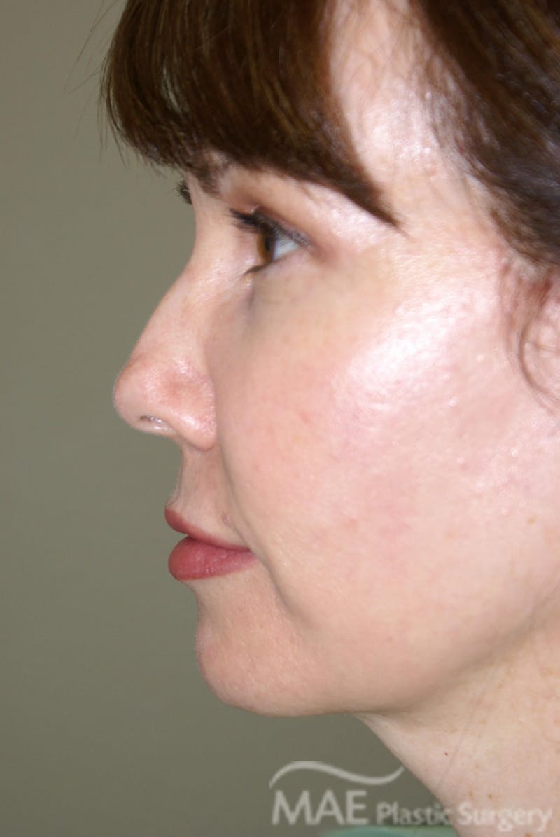 Facelift Before & After Gallery - Patient 164529 - Image 6