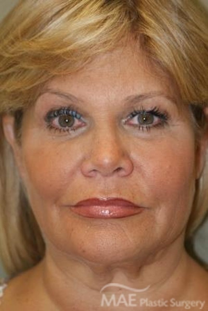 Facelift Before & After Gallery - Patient 167507 - Image 1