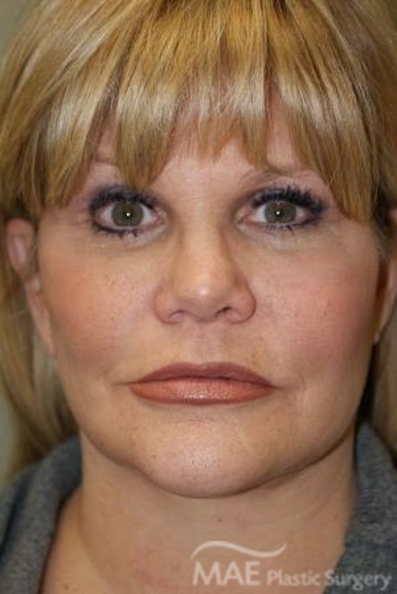 Facelift Before & After Gallery - Patient 167507 - Image 2