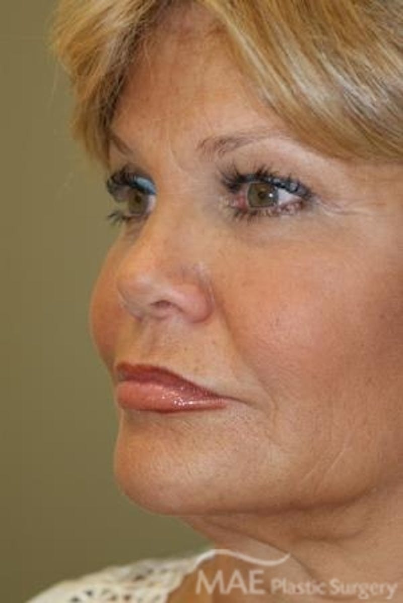 Facelift Before & After Gallery - Patient 167507 - Image 3