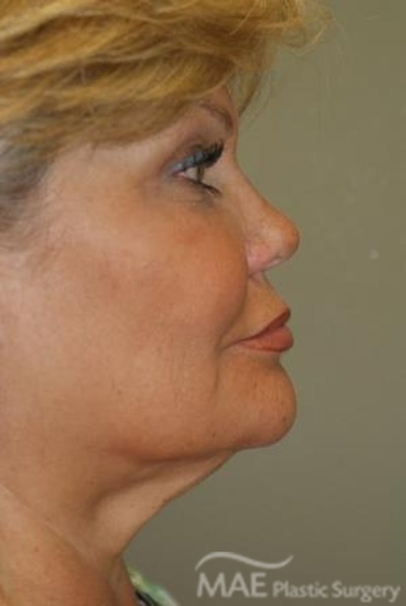 Facelift Before & After Gallery - Patient 167507 - Image 5