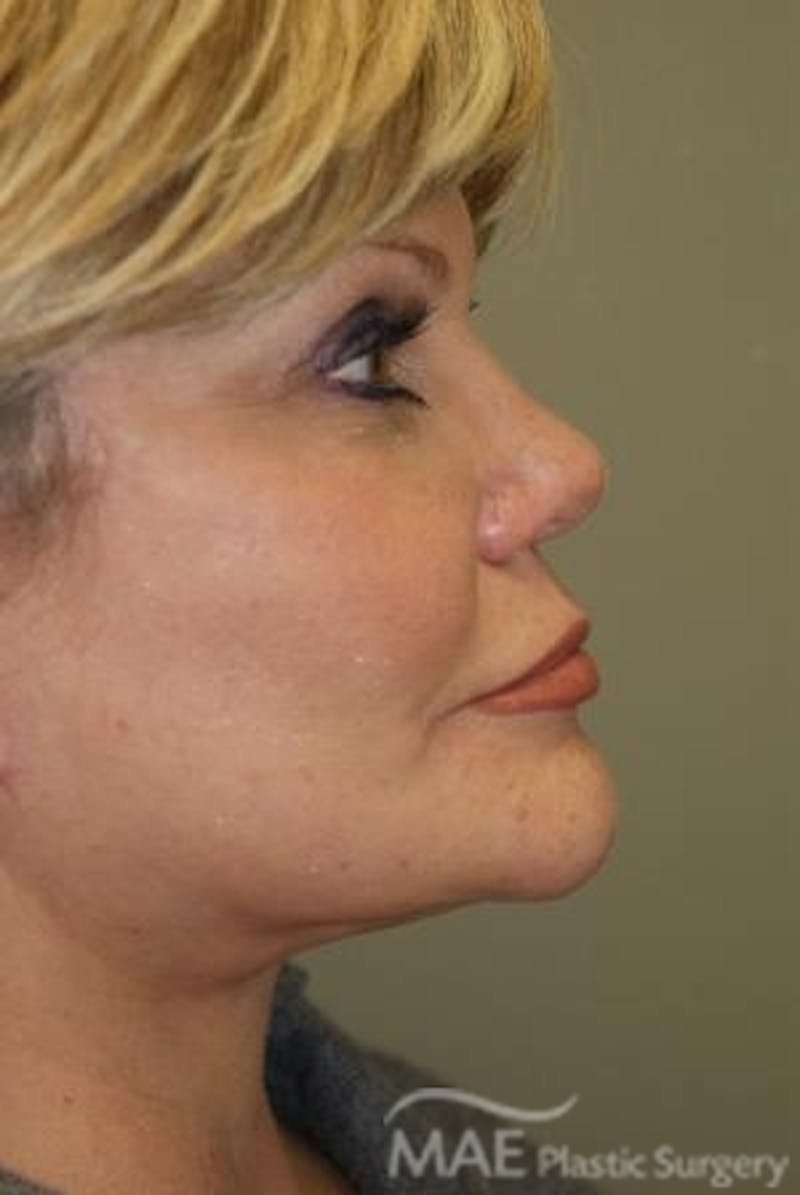 Facelift Before & After Gallery - Patient 167507 - Image 6