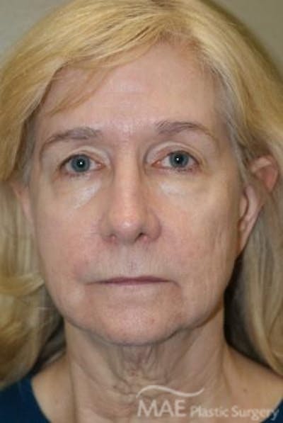 Facelift Before & After Gallery - Patient 165891 - Image 1