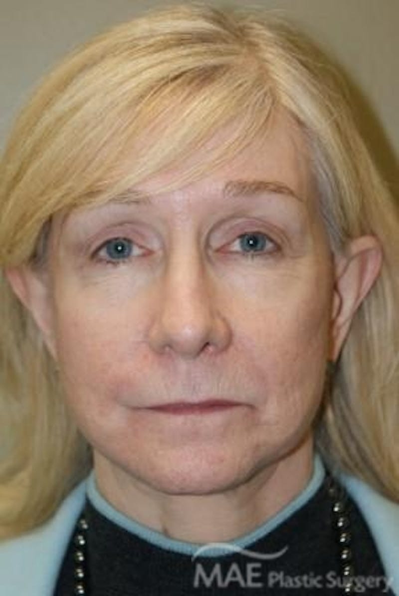 Facelift Before & After Gallery - Patient 165891 - Image 2