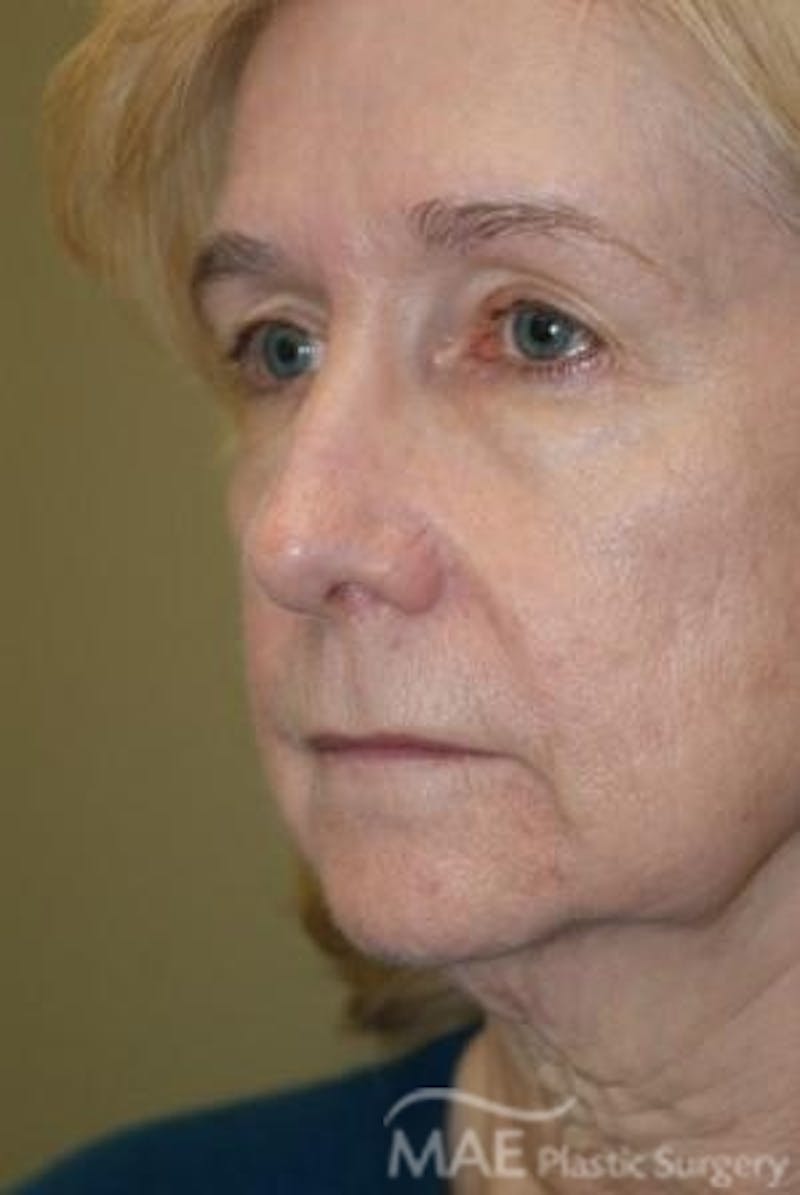 Facelift Before & After Gallery - Patient 165891 - Image 3