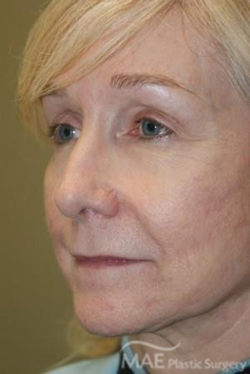 Facelift Before & After Gallery - Patient 165891 - Image 4