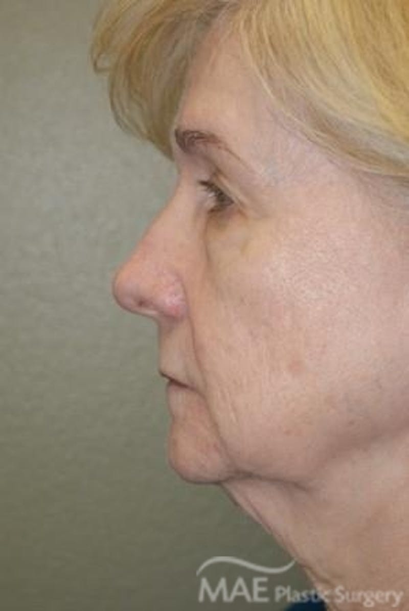 Facelift Before & After Gallery - Patient 165891 - Image 5