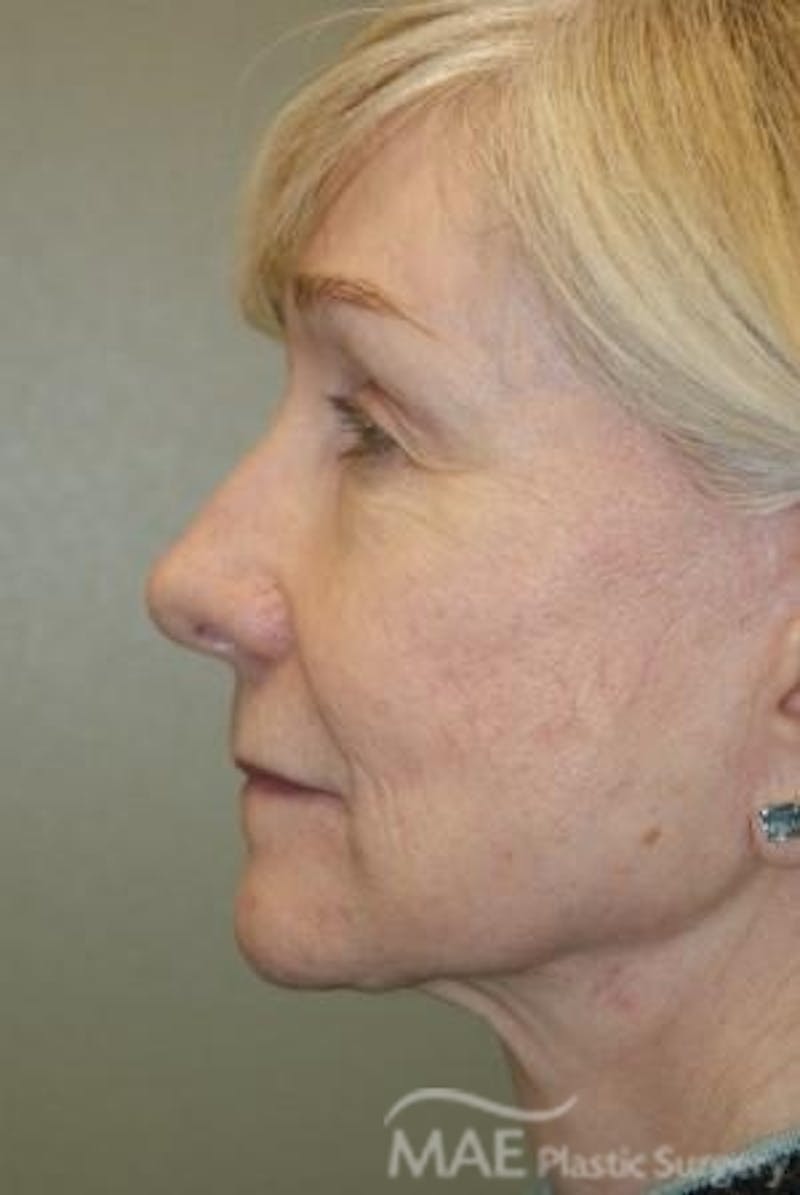 Facelift Before & After Gallery - Patient 165891 - Image 6