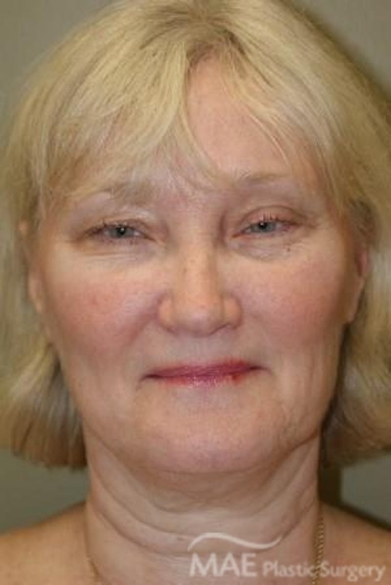 Facelift Before & After Gallery - Patient 399832 - Image 1