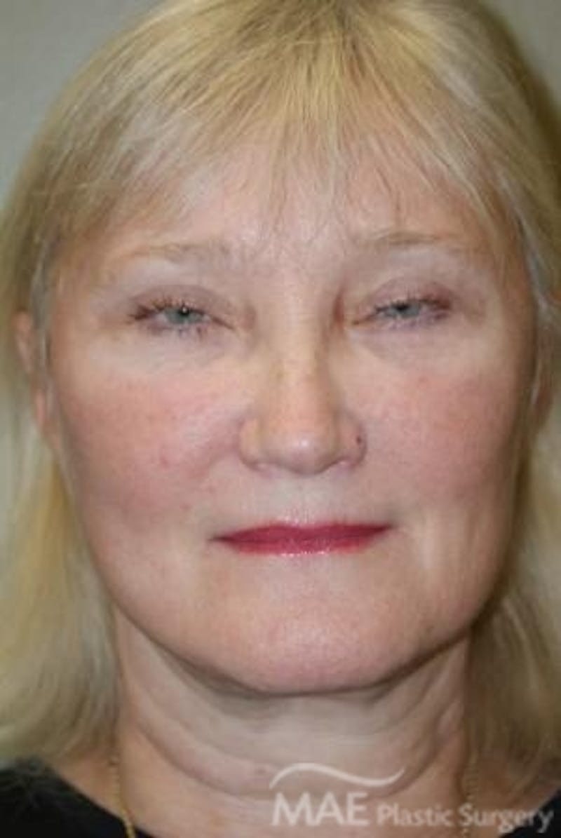 Facelift Before & After Gallery - Patient 399832 - Image 2