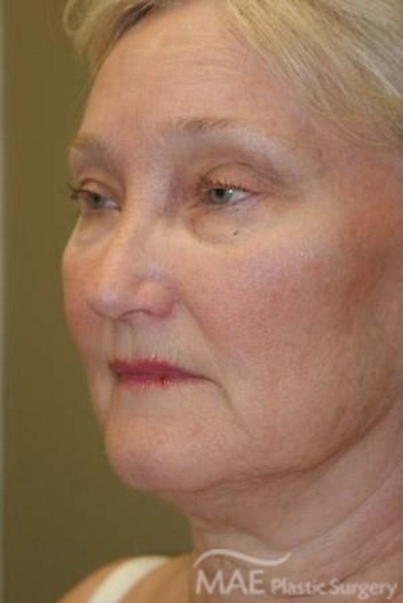 Facelift Before & After Gallery - Patient 399832 - Image 3