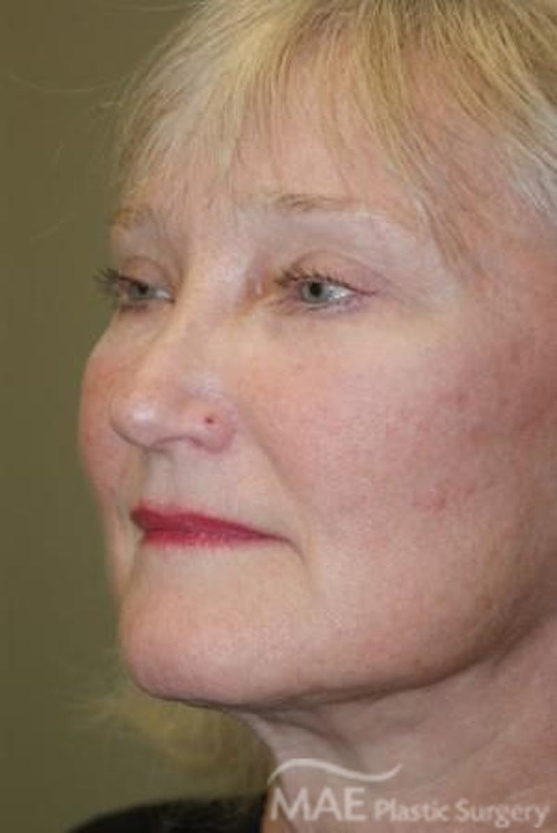 Facelift Before & After Gallery - Patient 399832 - Image 4