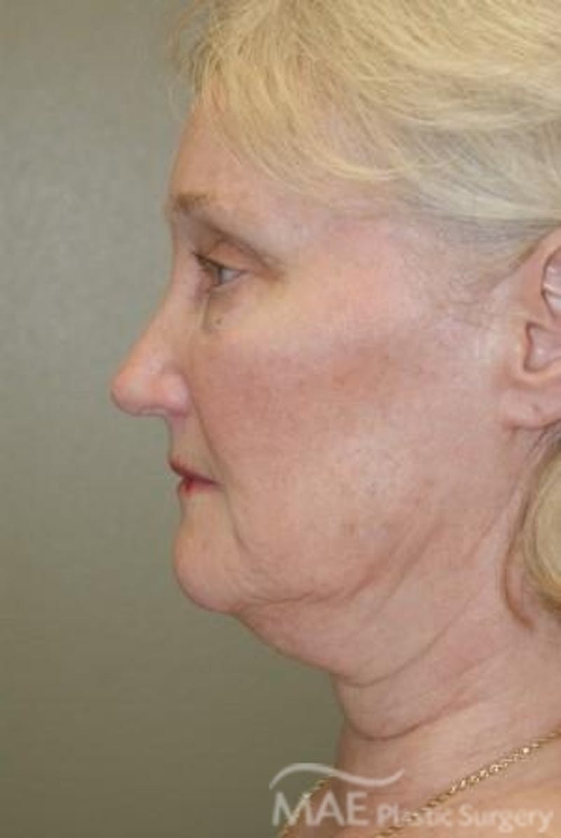 Facelift Before & After Gallery - Patient 399832 - Image 5