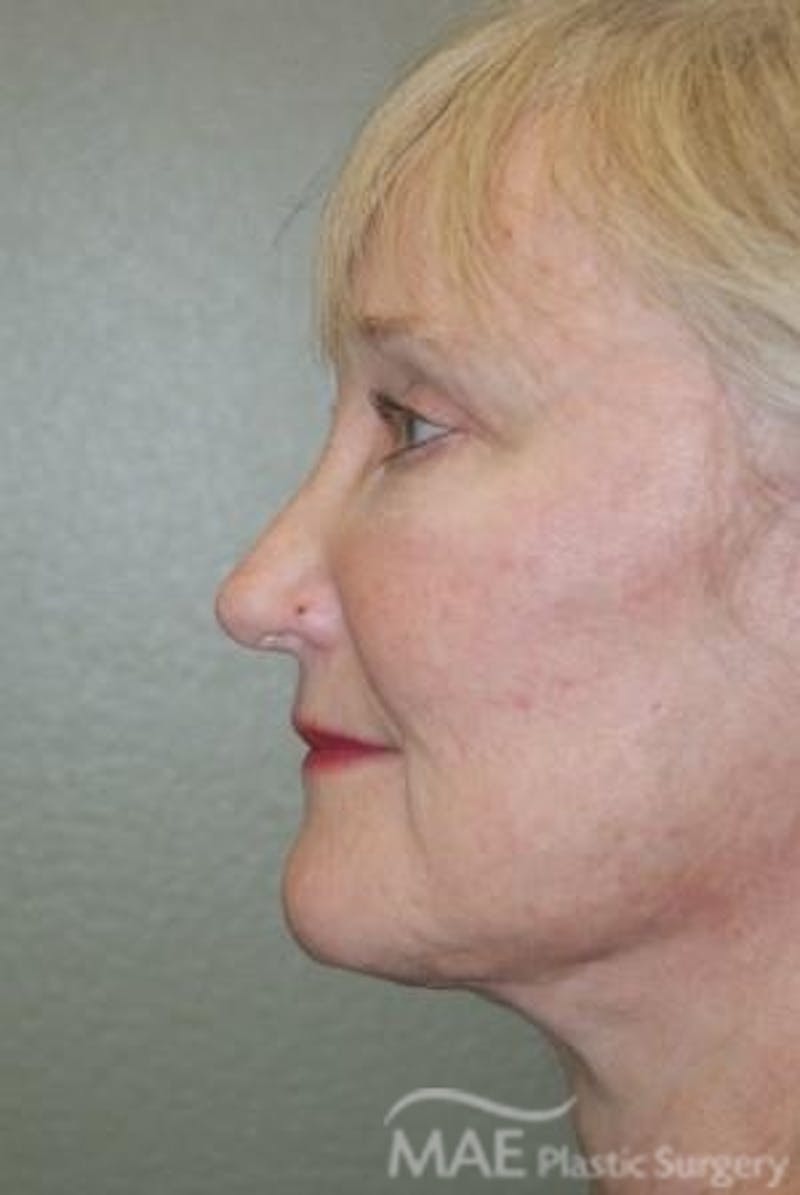 Facelift Before & After Gallery - Patient 399832 - Image 6