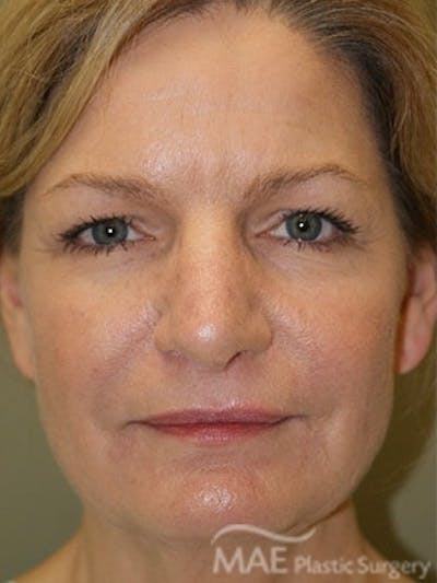 Facelift Before & After Gallery - Patient 628347 - Image 1