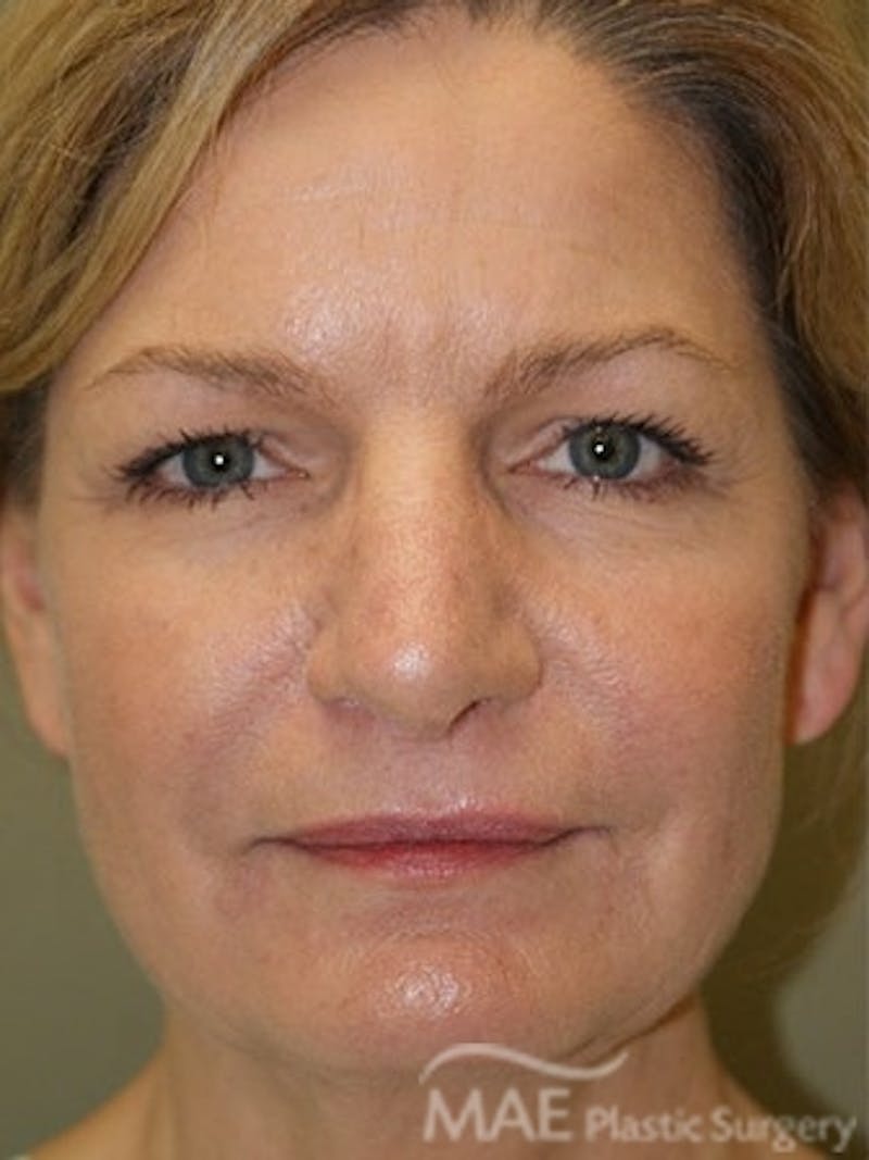 Facelift Before & After Gallery - Patient 628347 - Image 1