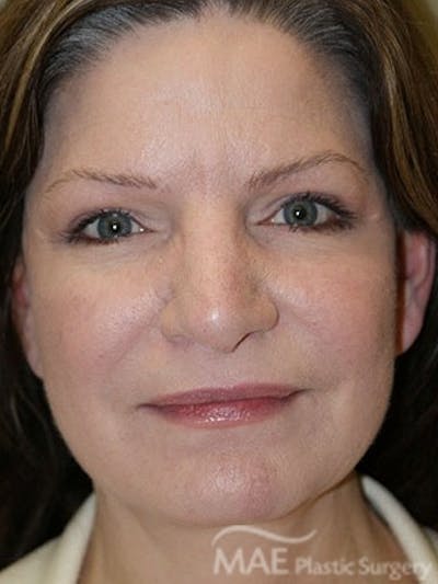 Facelift Before & After Gallery - Patient 628347 - Image 2