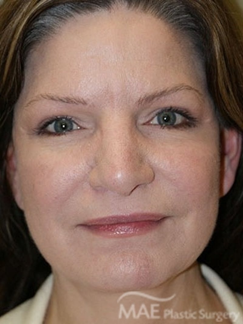Facelift Before & After Gallery - Patient 628347 - Image 2