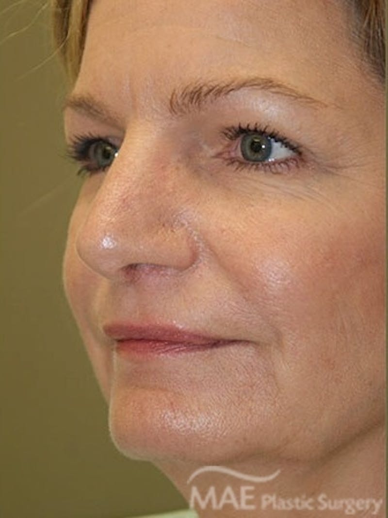 Facelift Before & After Gallery - Patient 628347 - Image 3