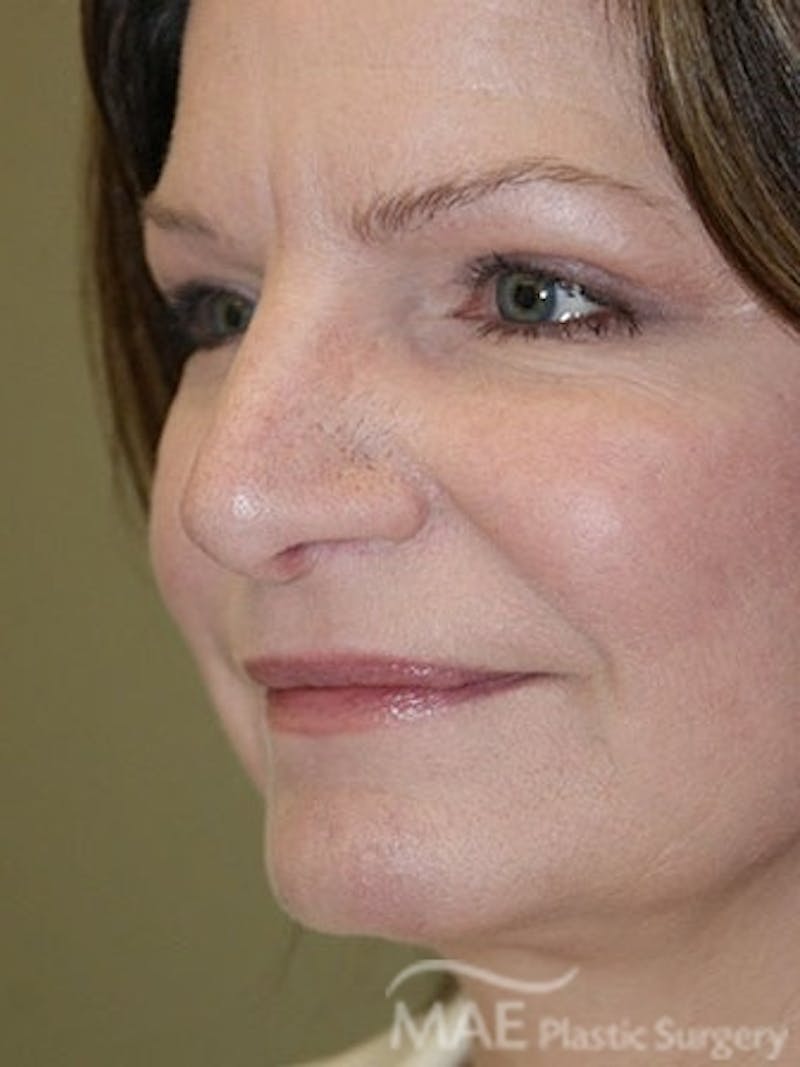 Facelift Before & After Gallery - Patient 628347 - Image 4