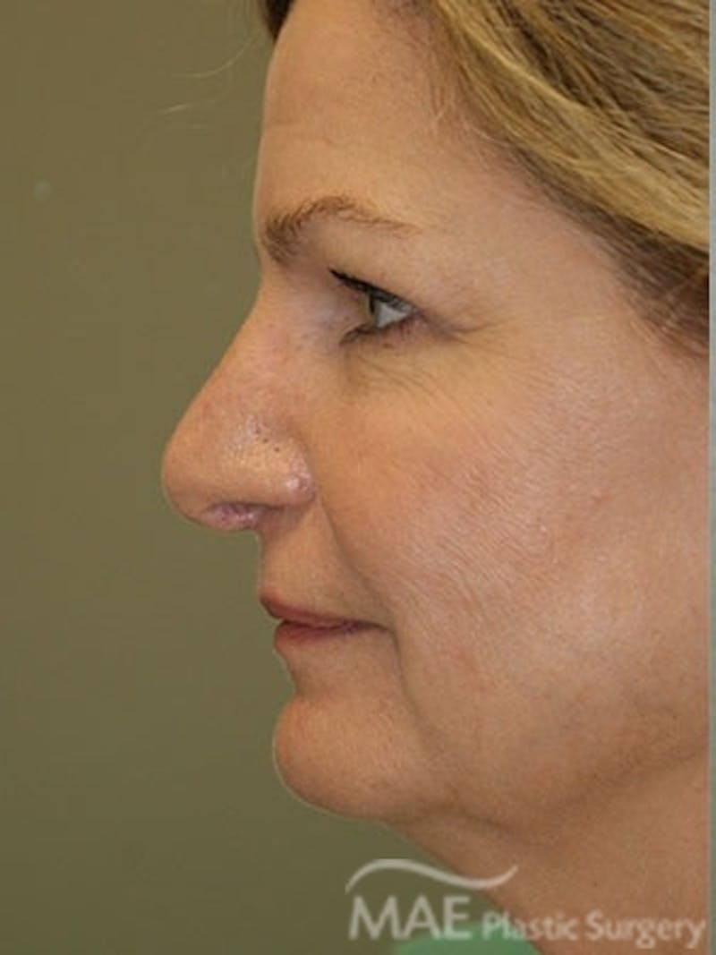 Facelift Before & After Gallery - Patient 628347 - Image 5