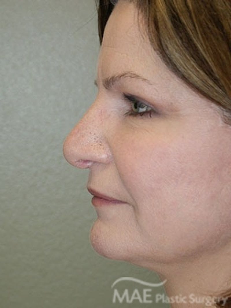 Facelift Before & After Gallery - Patient 628347 - Image 6