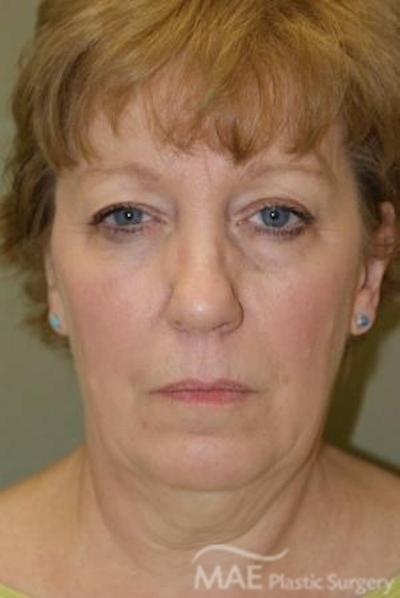 Facelift Before & After Gallery - Patient 291008 - Image 1