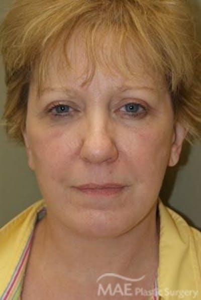 Facelift Before & After Gallery - Patient 291008 - Image 2