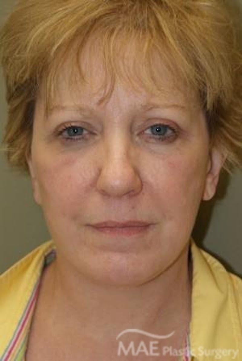 Facelift Before & After Gallery - Patient 291008 - Image 2