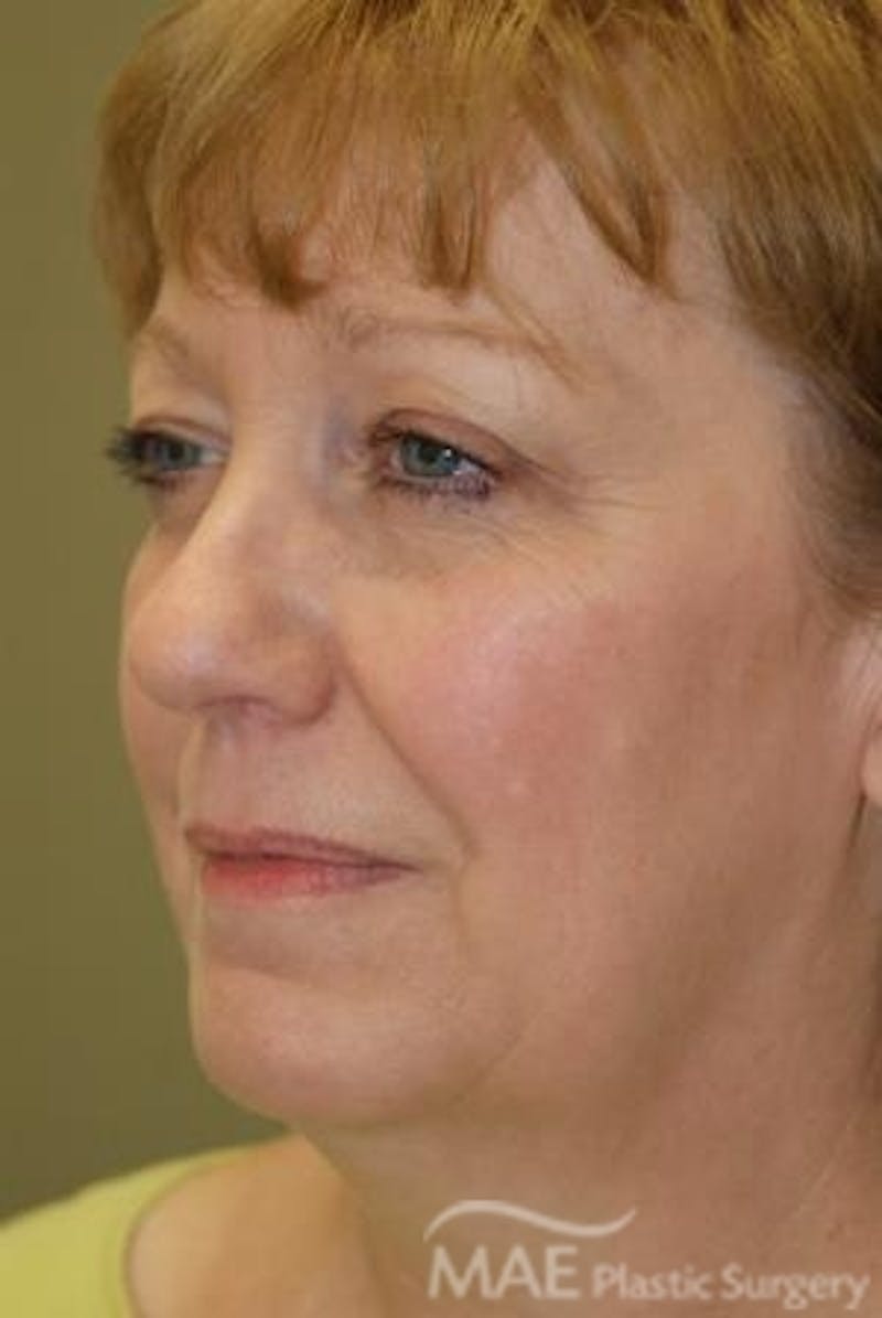 Facelift Before & After Gallery - Patient 291008 - Image 3