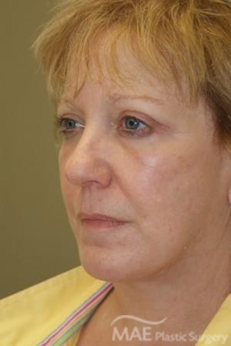 Facelift Before & After Gallery - Patient 291008 - Image 4