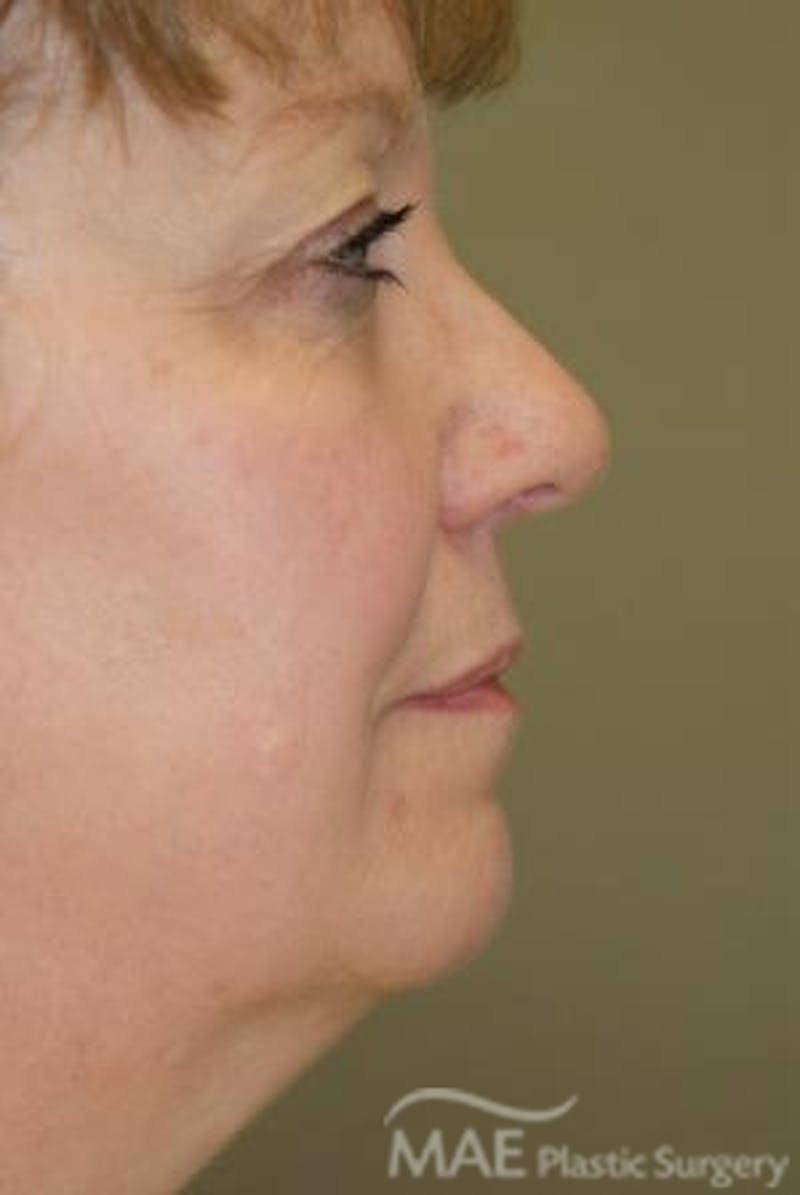 Facelift Before & After Gallery - Patient 291008 - Image 5