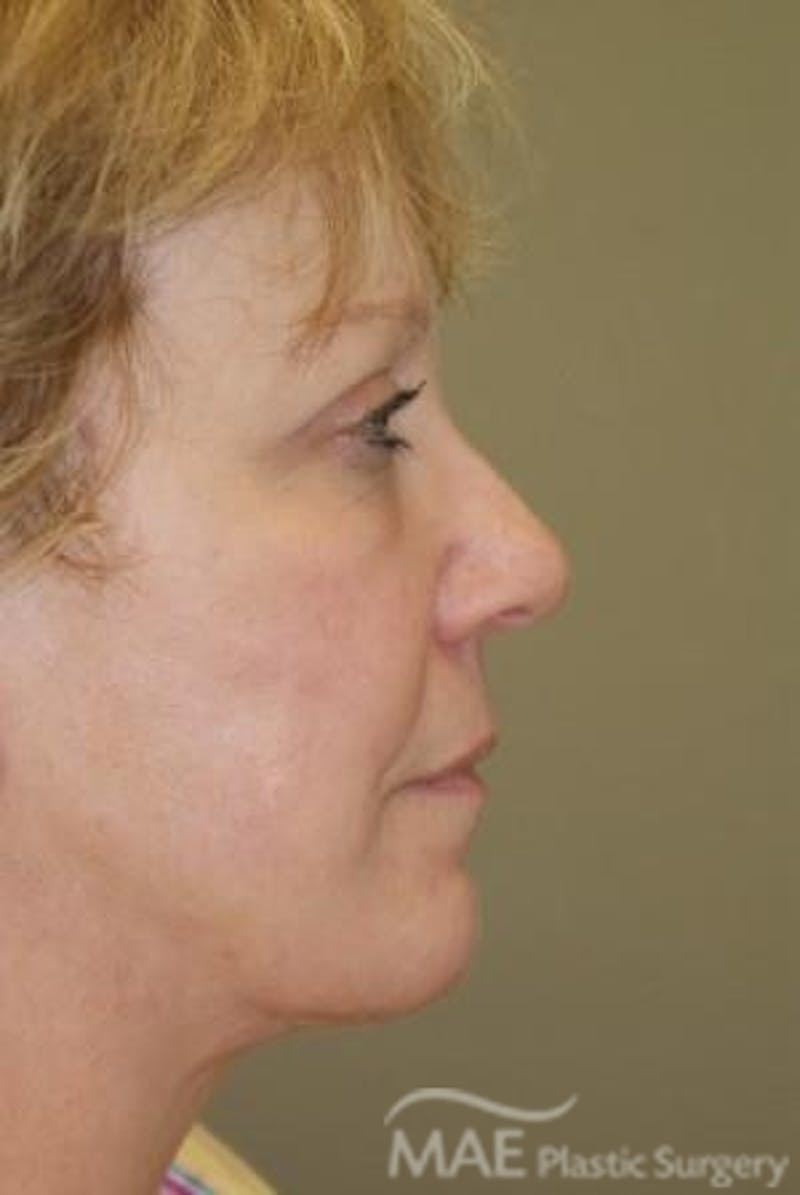 Facelift Before & After Gallery - Patient 291008 - Image 6