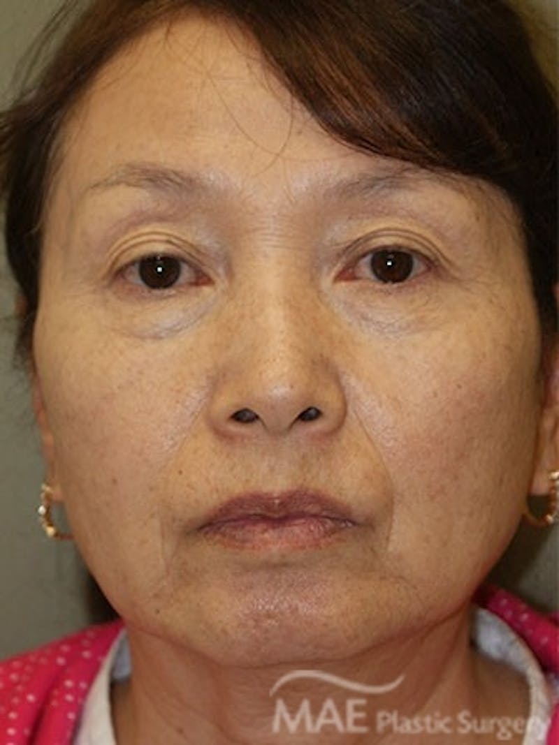 Facelift Before & After Gallery - Patient 270498 - Image 1