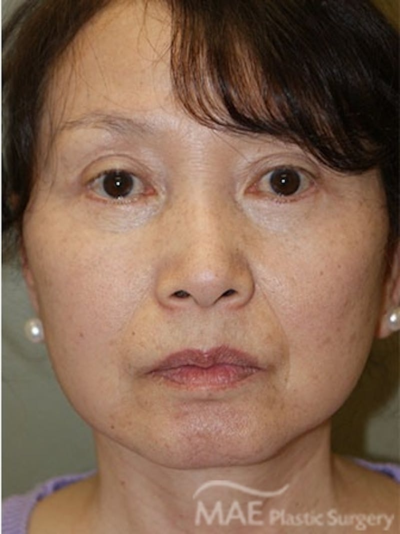 Facelift Before & After Gallery - Patient 270498 - Image 2