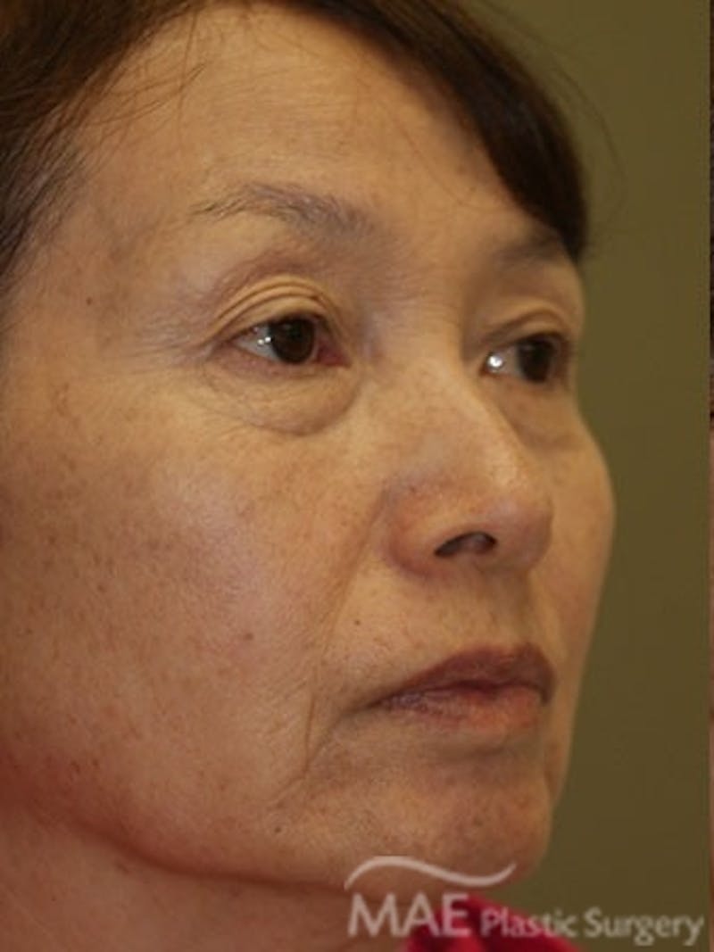 Facelift Before & After Gallery - Patient 270498 - Image 3