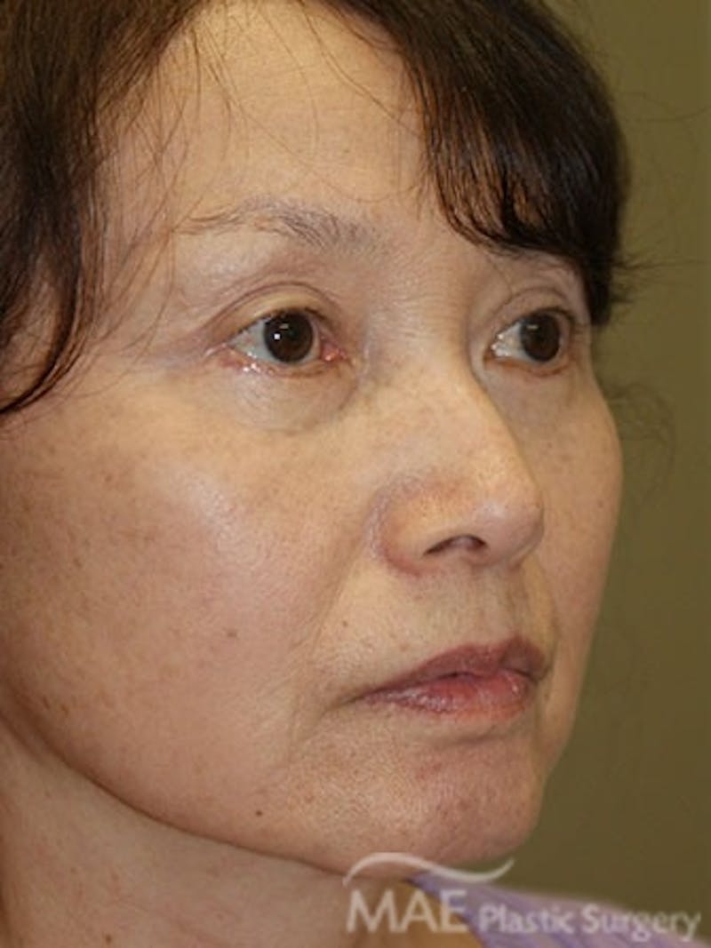 Facelift Before & After Gallery - Patient 270498 - Image 4