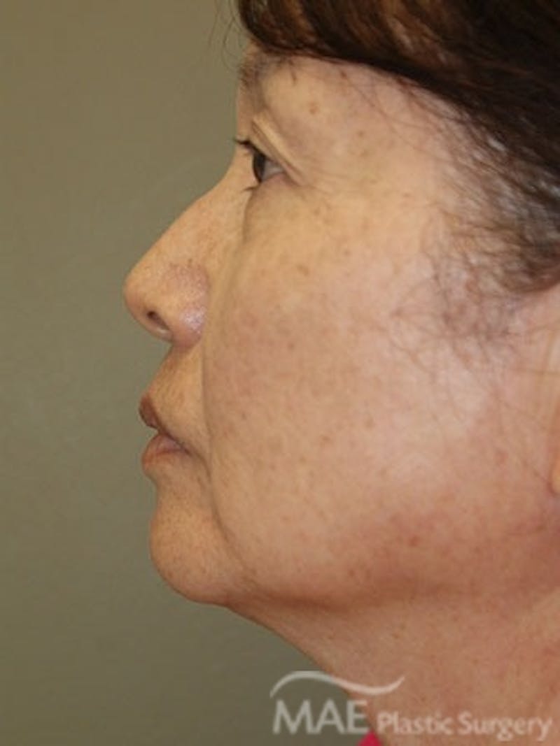 Facelift Before & After Gallery - Patient 270498 - Image 5