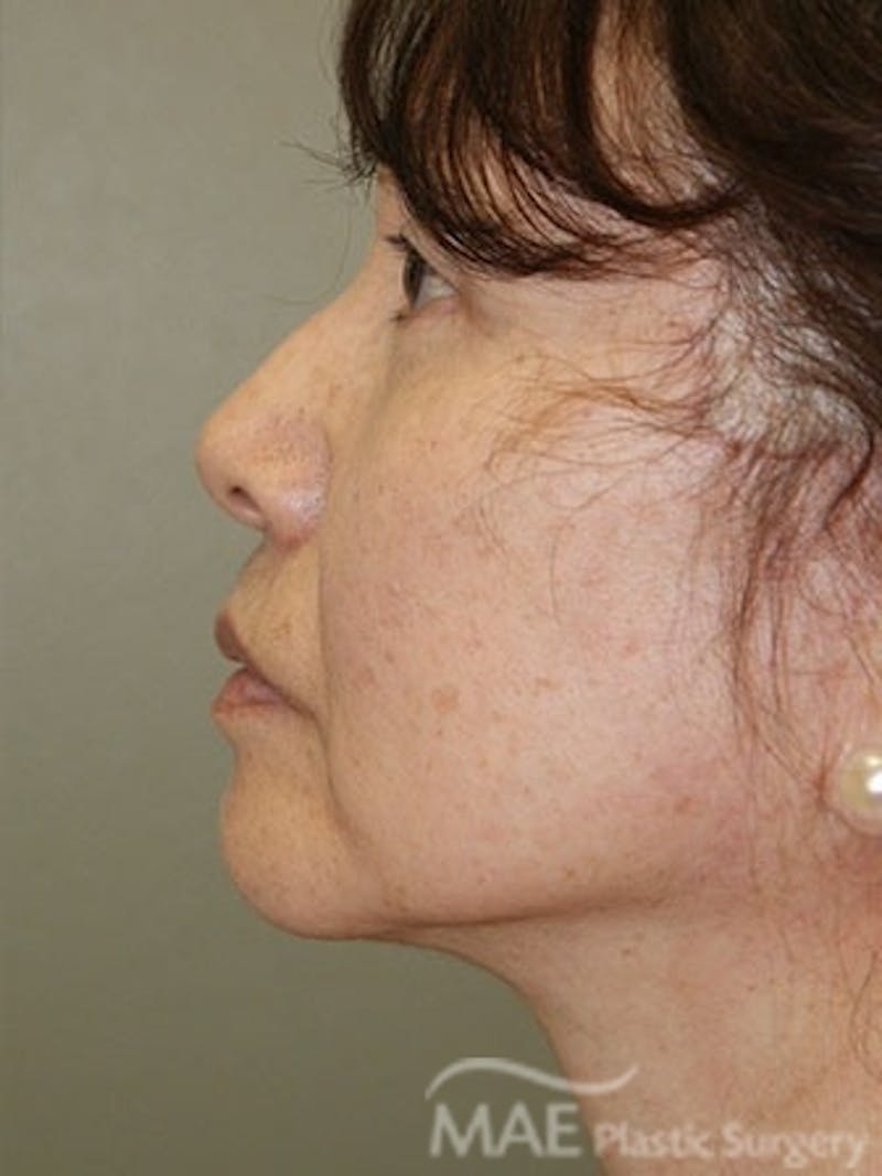 Facelift Before & After Gallery - Patient 270498 - Image 6