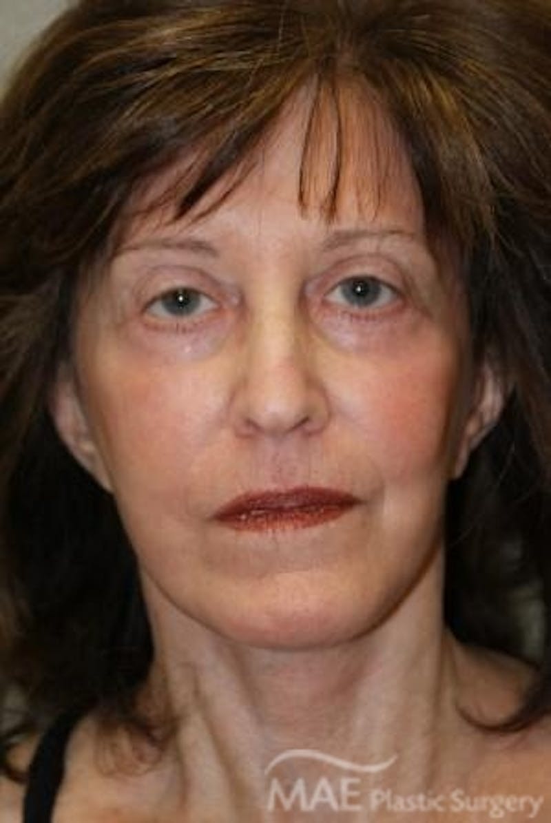 Facelift Before & After Gallery - Patient 164494 - Image 1