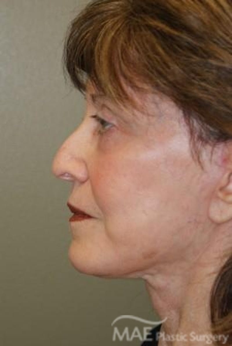 Facelift Before & After Gallery - Patient 164494 - Image 6