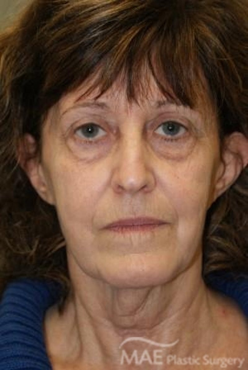 Facelift Before & After Gallery - Patient 164494 - Image 2