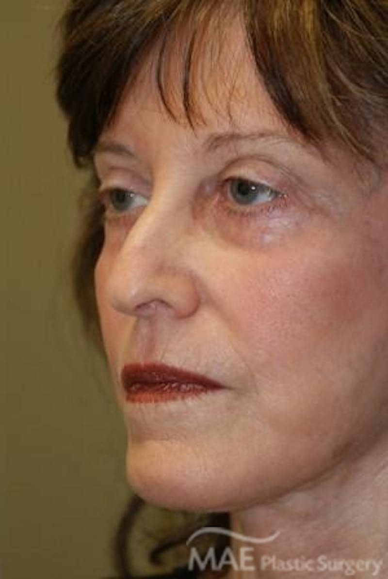 Facelift Before & After Gallery - Patient 164494 - Image 4