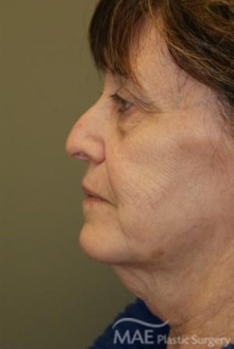 Facelift Before & After Gallery - Patient 164494 - Image 5