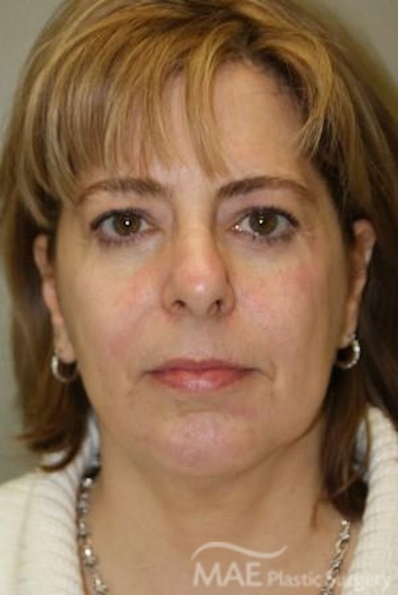 Facelift Before & After Gallery - Patient 292160 - Image 1