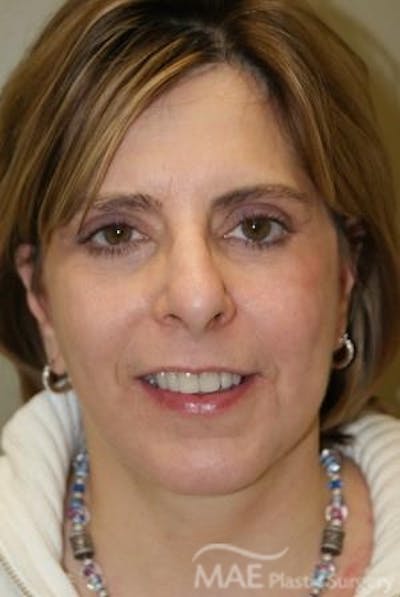 Facelift Before & After Gallery - Patient 292160 - Image 2