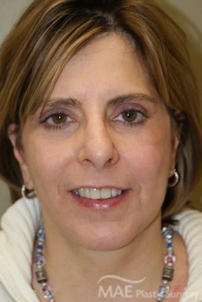Facelift Before & After Gallery - Patient 292160 - Image 2